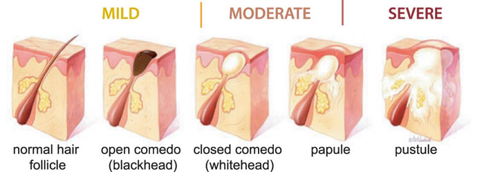 tipos de cravo e acne